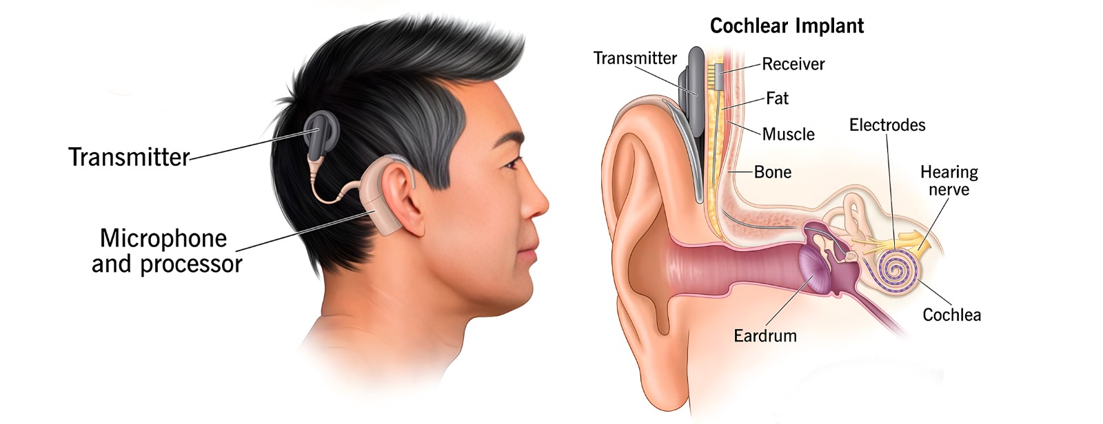 Cochlear Implant