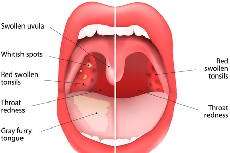 Tonsillitis Treatment