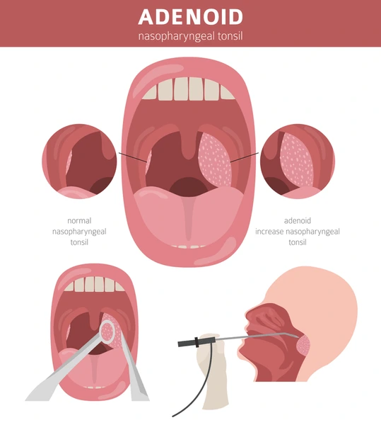 Adenoids Treatment