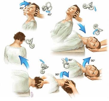 Vertigo Treatment
